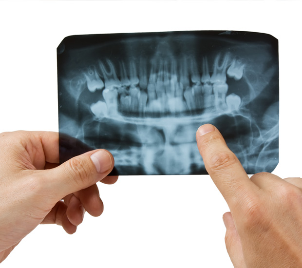 Marble Hill 7 Signs You Need Endodontic Surgery