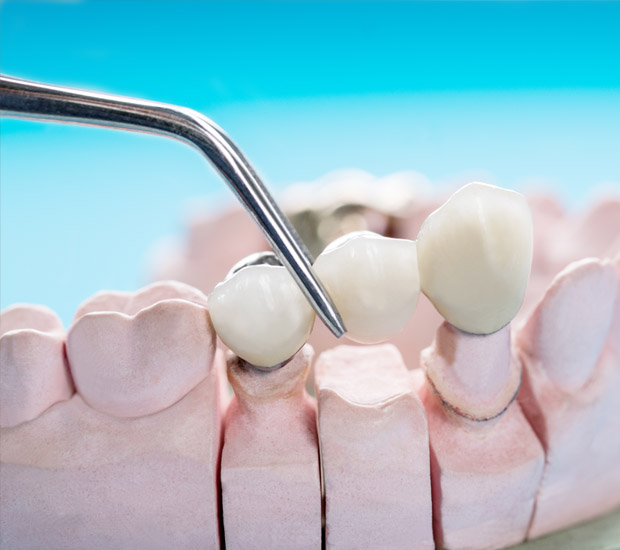 Marble Hill Dental Bridges