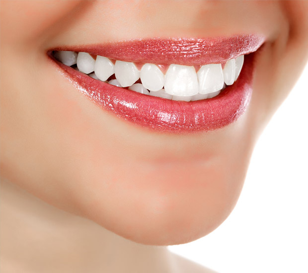 Marble Hill Teeth Whitening