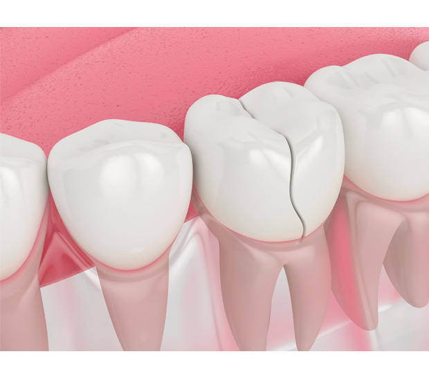 Marble Hill Types of Dental Root Fractures
